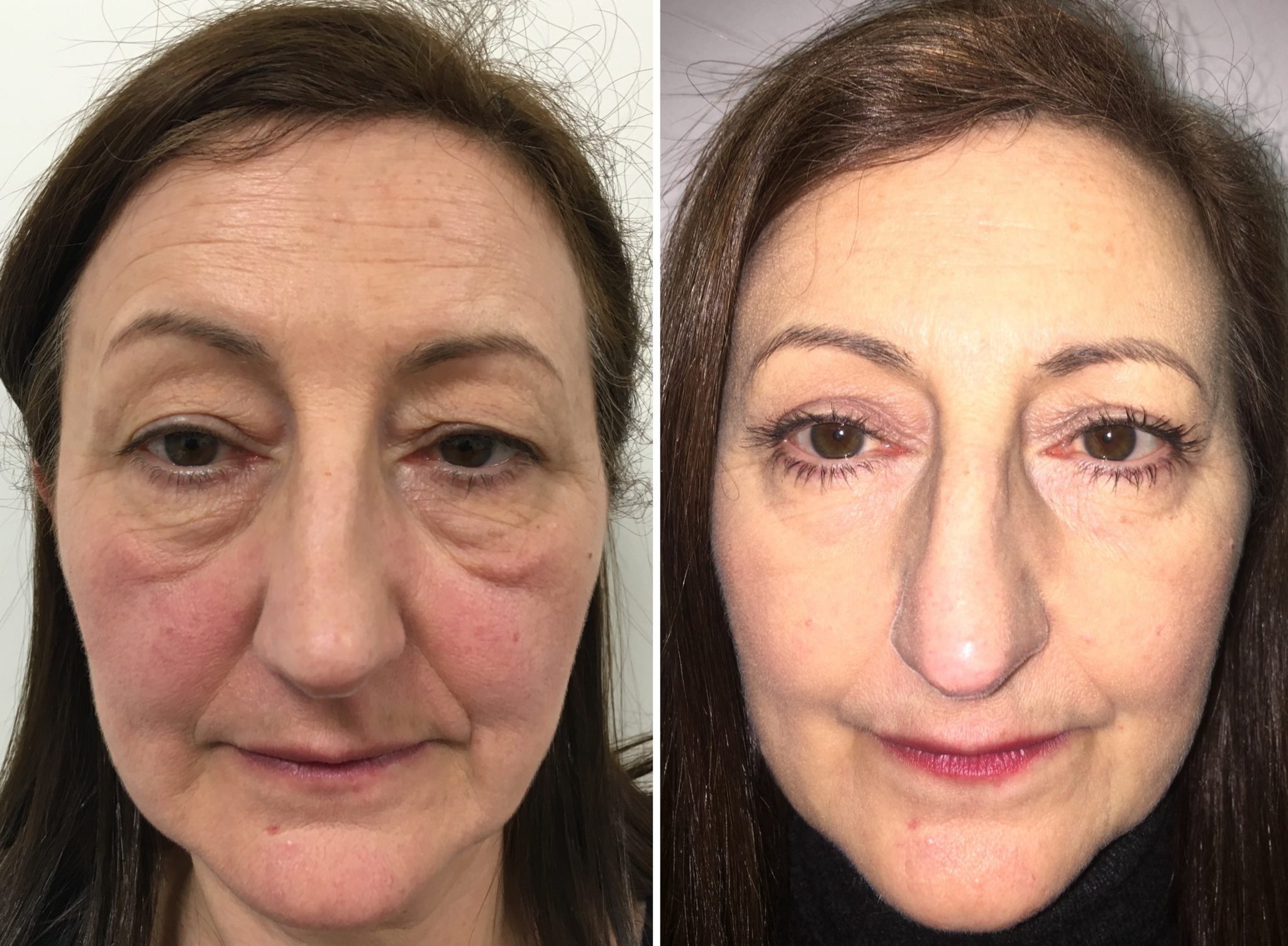 Eyelid bag removal blepharoplasty