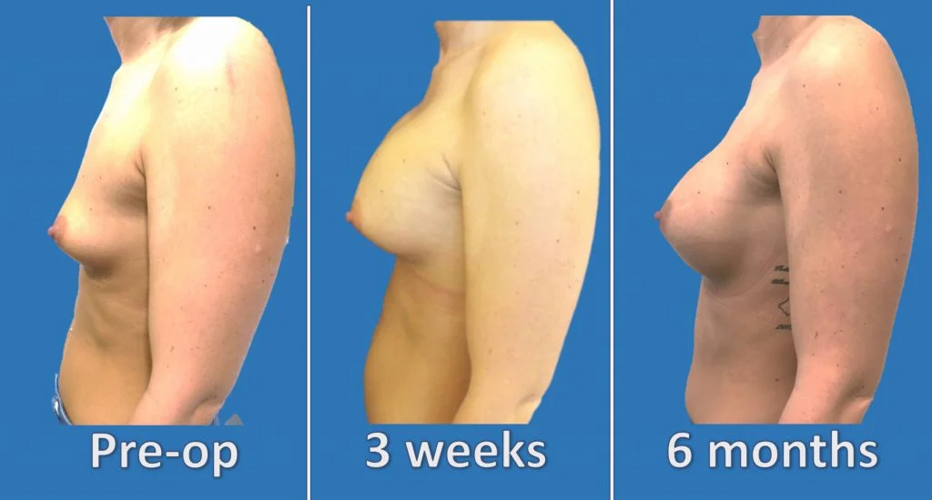 The process of 'drop and fluff' – how implants settle following breast  augmentation