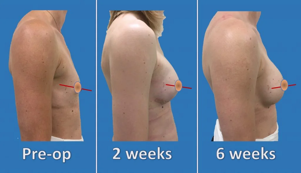 Drop and Fluff Timeline: Breast Augmentation Recovery