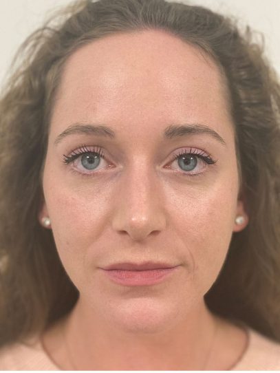 Rhinoplasty | William Townley